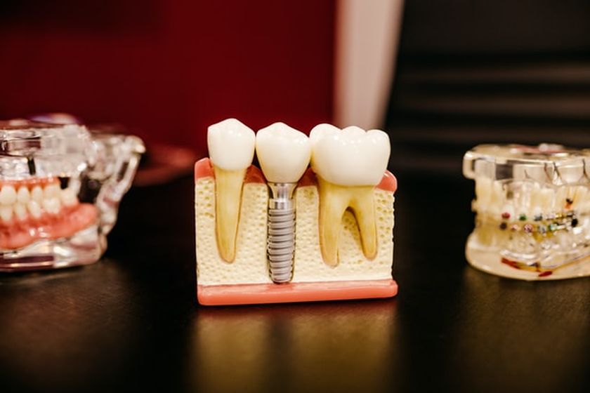 Dental Implants in Manvel