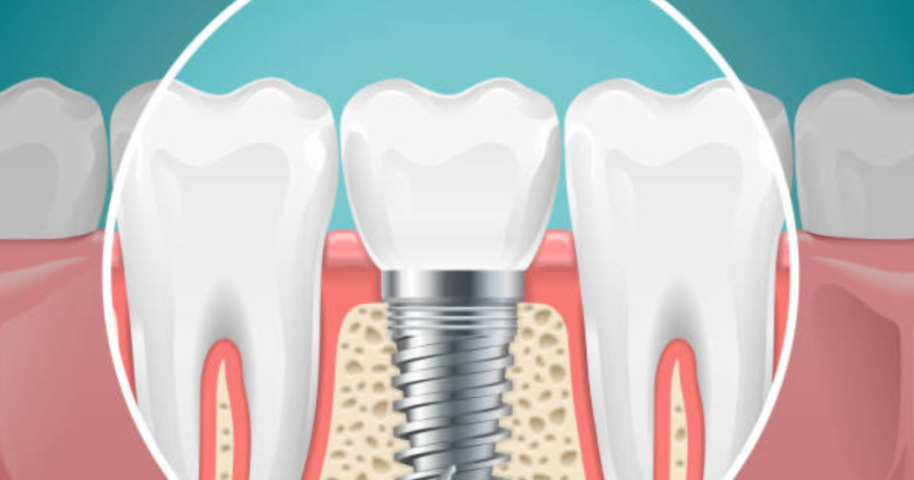 Dentist in Manvel, dental services Dental Implant in Manvel