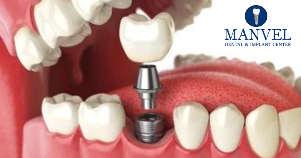 Manvel Dentist, Dental & Implant Centre in Manvel, el monte dentist, Dentist in Manvel ,