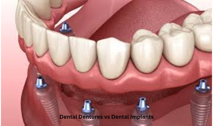 Dental Dentures vs Dental Implants