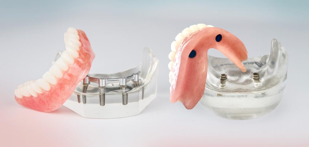 Are Implant Retained Dentures Right for You?