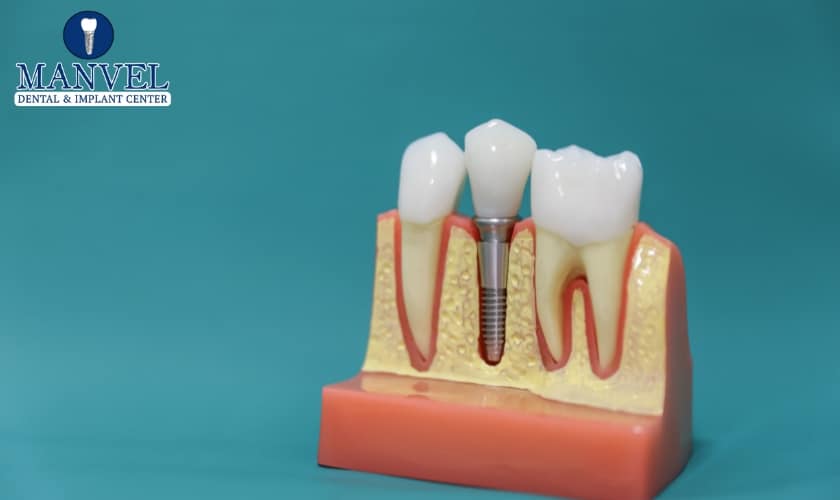 Dental Implants in Manvel, TX, Manvel Dental