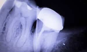 Post Root Canal infection Treatment
